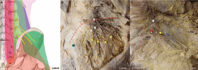 수압박리술 - 그림 1. 상둔신경(superior cluneal nerve)의 경로에 대한 개략도(A)입