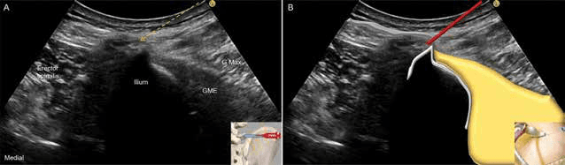 수압박리술 - 그림 10. 흉요근막을 목표로 하는 평면내(lateral to medial) 접근법(A)입