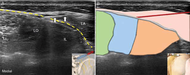 수압박리술 - 그림 11. 장골능(iliac crest) 상연을 목표로 하는 평면내(lateral to 