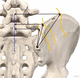 수압박리술 - 그림 2. 두 지점 사이의 거리 측정에 대한 도해입니다.