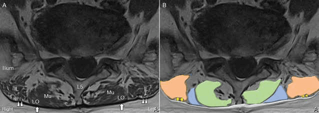 수압박리술 - 그림 3. 자기공명영상(magnetic resonance imaging, MRI)(A)과 