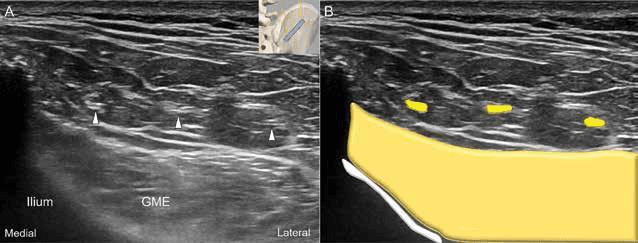 수압박리술 - 그림 4. 초음파 영상(A)과 상둔신경 분지들의 단축 영상에 대한 개략도(B)입니다.