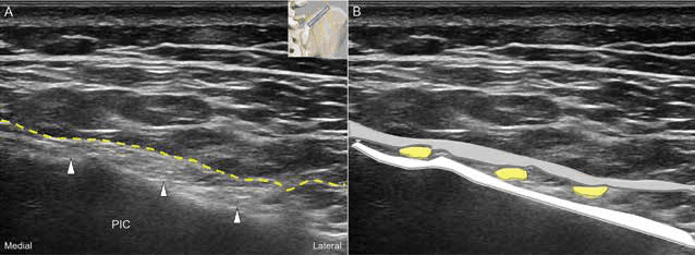 수압박리술 - 그림 5. 상둔신경 분지들의 단축 영상에 대한 초음파 영상(A)과 개략도(B)입니다.