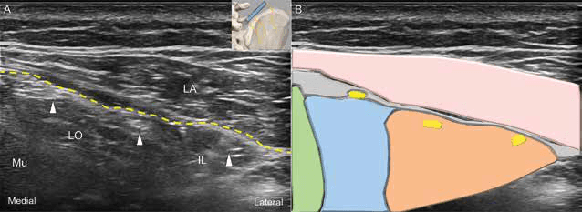 수압박리술 - 그림 6. 상둔신경 분지들에 대한 초음파 영상(A)과 개략도(B)입니다.