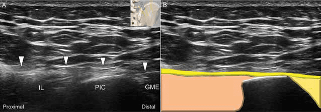 수압박리술 - 그림 7. 상둔신경 중간분지(intermediate branches)의 장축 영상에 대한 