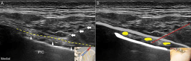 수압박리술 - 그림 8. 흉요근막(thoracolumbar fascia) 사이의 상둔신경(단축 영상)을 