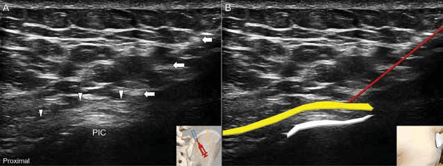 수압박리술 - 그림 9. 장축 영상에서 상둔신경 원위부를 목표로 하는 평면내 접근법(A)입니다. 해당하는