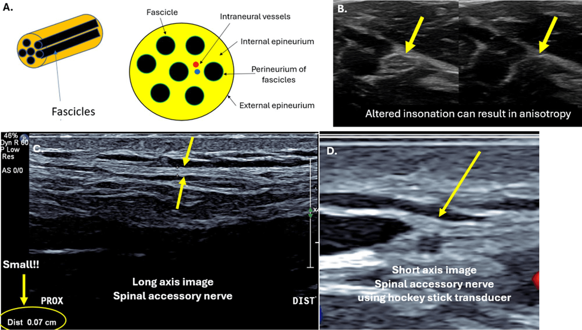 흉쇄유돌근 - 그림 2. 말초신경(peripheral nerves)의 구조와 초음파 소견입니다. (a) 