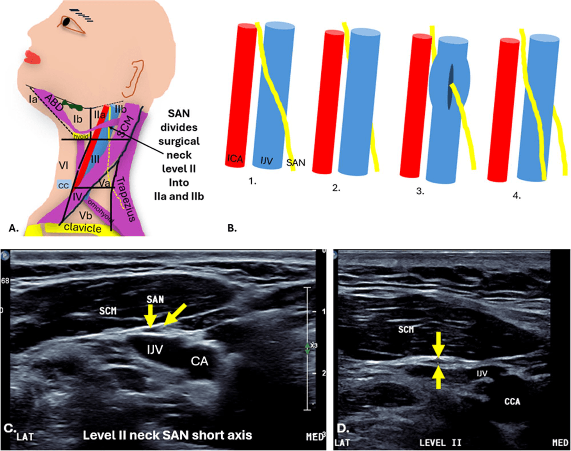 흉쇄유돌근 - 그림 3. 수술적 경부 II 단계(surgical neck level II)를 통과하는 상