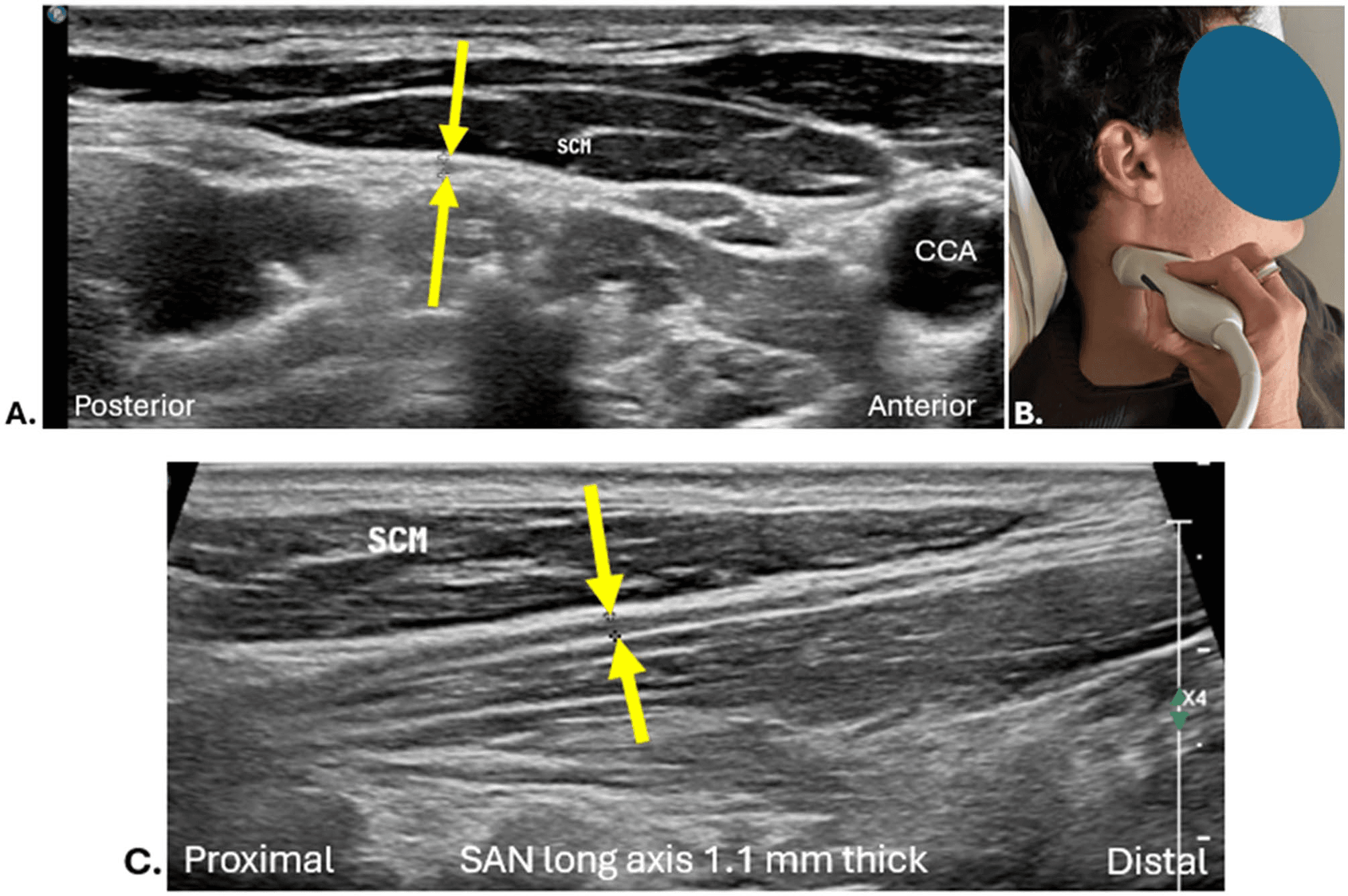 흉쇄유돌근 - 그림 4. 흉쇄유돌근(sternocleidomastoid, SCM) 심부를 주행하는 척수부