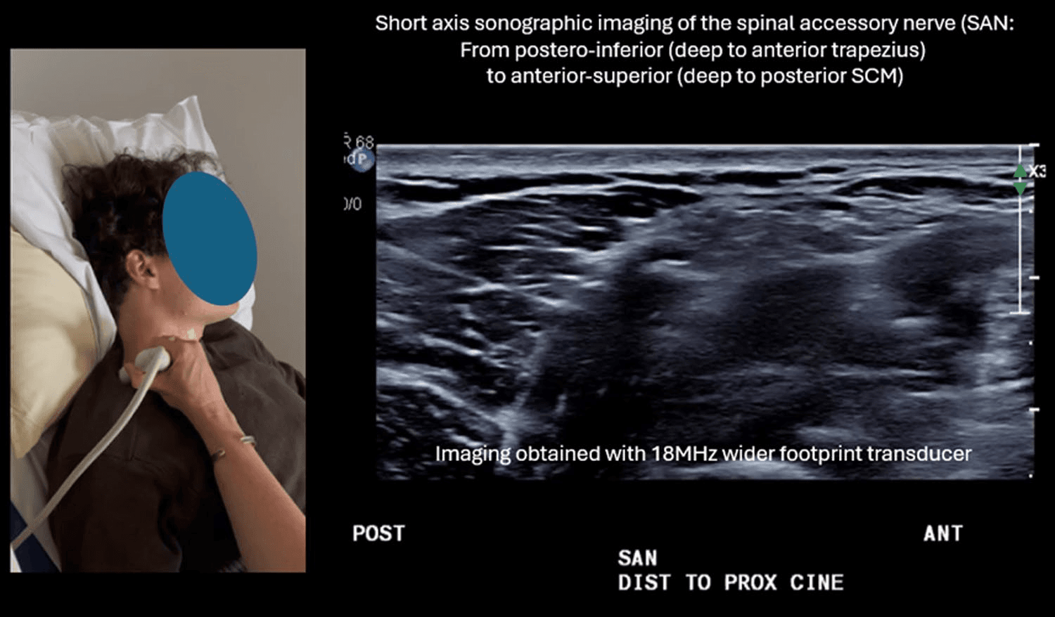 흉쇄유돌근 - 그림 5. 경부 후삼각(posterior triangle of the neck, 수술적 영