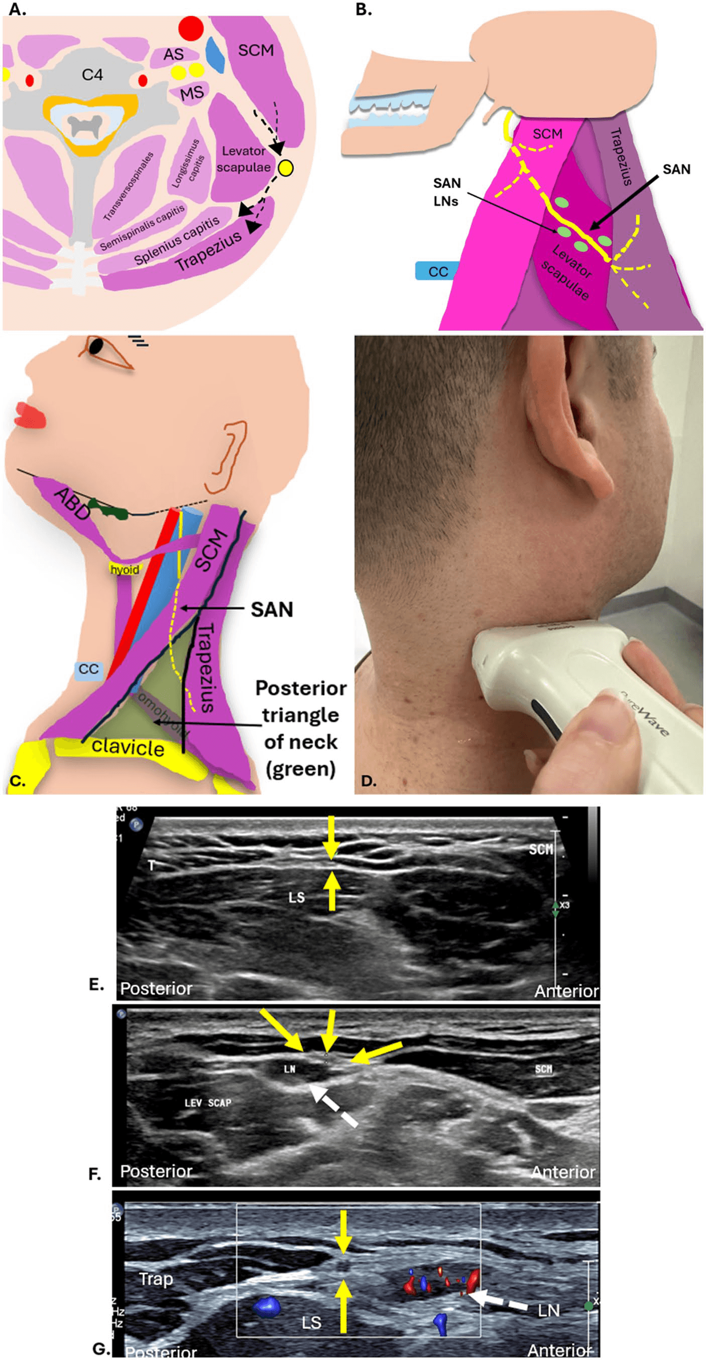 흉쇄유돌근 - 그림 6. 승모근(trapezius muscle) 심부를 횡단하며 동시에 이를 지배하는 척