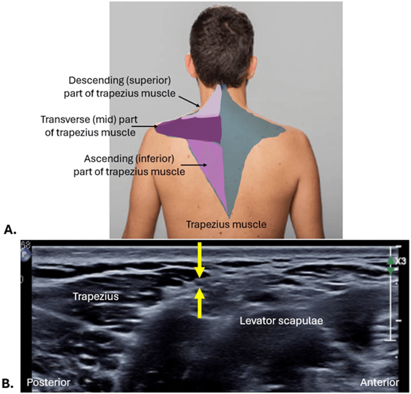 흉쇄유돌근 - 그림 8. 대이개신경(great auricular nerve, GAN)의 해부학적 구조와 