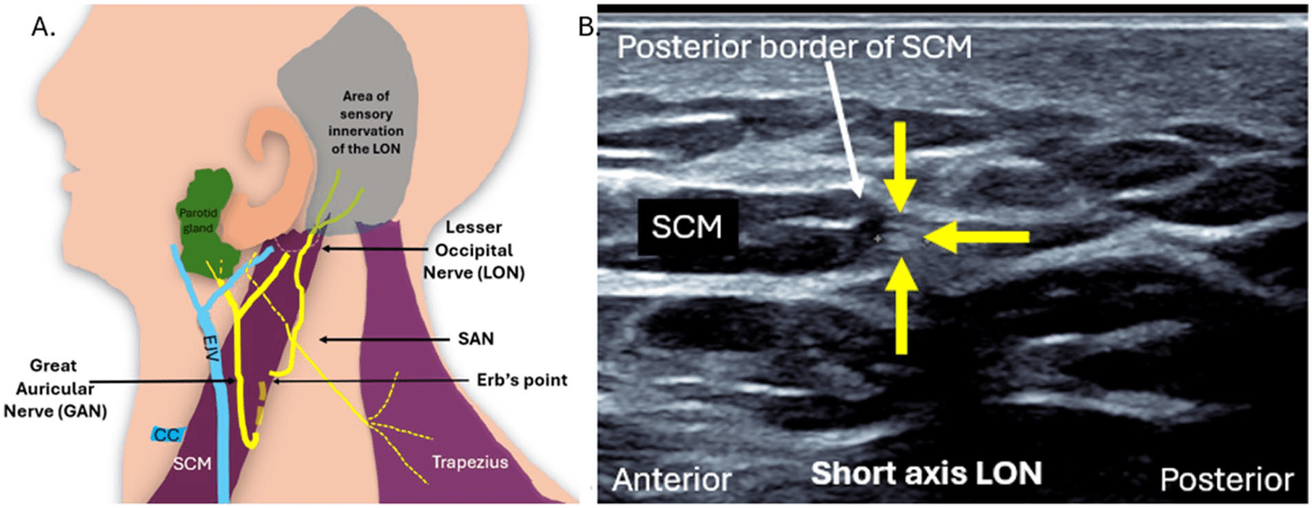 흉쇄유돌근 - 그림 9. 척수부신경(SAN)의 초음파 해부학적 구조와 영상입니다. (a) 척수부신경의 상