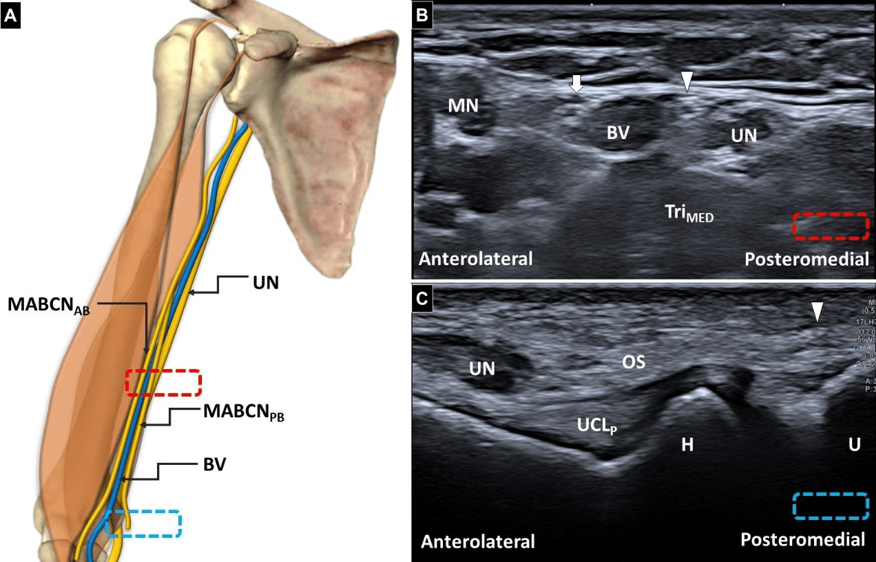 척골신경병증 - 그림 1. 팔에서의 내측 전완피부신경(medial antebrachial cutaneous nerve)의 해부학적 구조 (A)입니다. 단축 초음