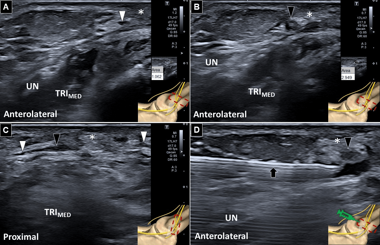 척골신경병증 - 그림 2. 초음파검사(ultrasonography)에서 후분지(posterior branch)의 정상 분절을 보여주고 있습니다