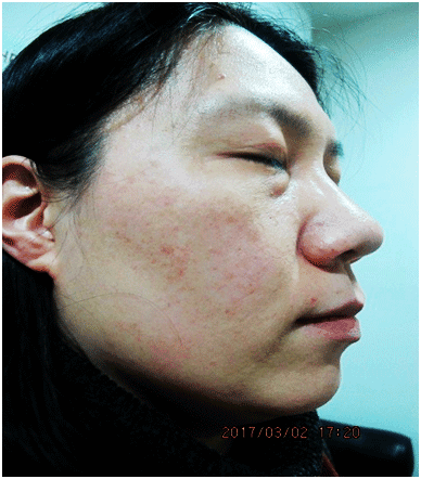 내측상과 - 그림 5 척골 터널 증후군(cubital tunnel syndrome)에 대한 외과적 술식들