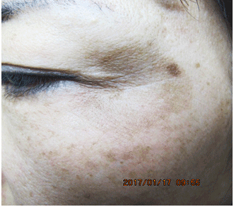 일광흑자 - 그림 1: 좌측 안와연 외측부의 단일한 큰 원형 갈색 반점