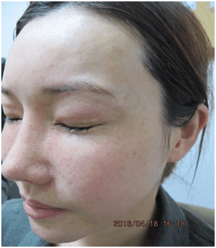 일광흑자 - 그림 10: 치료 종료 후 6개월 추적관찰에서 재발이 없습니다