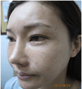 일광흑자 - 그림 11: 치료 종료 후 18개월 추적관찰에서 재발이 없습니다