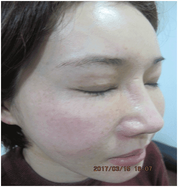 일광흑자 - 그림 12: 경계가 명확한 다수의 작은 원형 갈색 반점들