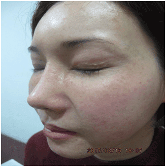 일광흑자 - 그림 13: 일광흑자들의 완전한 소실