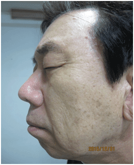 일광흑자 - 그림 14: 치료 종료 후 18개월 추적관찰에서 재발이 없습니다