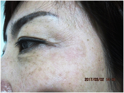 일광흑자 - 그림 2: 일광흑자(solar lentigo)의 완전한 소실