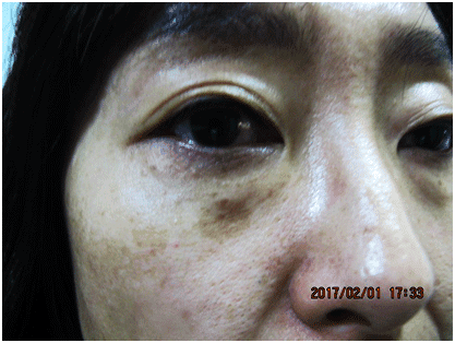 일광흑자 - 그림 3: 경계가 명확한 다수의 작은 갈색 반점들