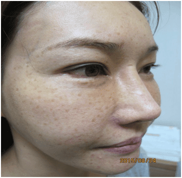 일광흑자 - 그림 4: 일광흑자들의 완전한 소실