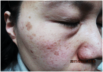 일광흑자 - 그림 6: 일광흑자의 완전한 소실