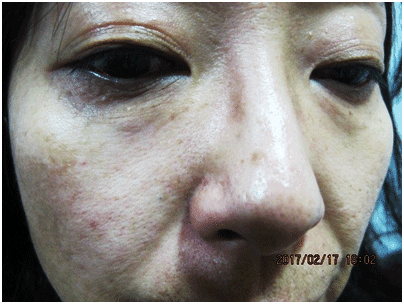 일광흑자 - 그림 7: 경계가 명확한 다수의 작은 갈색 반점들