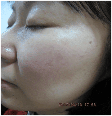 일광흑자 - 그림 8: 일광흑자들의 완전한 소실