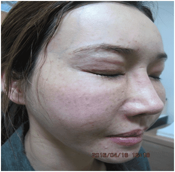 일광흑자 - 그림 9: 경계가 명확한 다수의 작은 원형 갈색 반점들