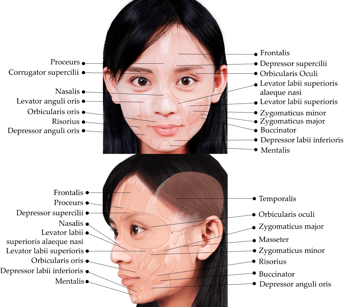 보툴리눔독소 - 안면 근육을 보여주는 도해입니다. 이미지는 공동저자(H.-C.C)의 얼굴을 출판 허가를 받아 각색한 것을 나타냅니다