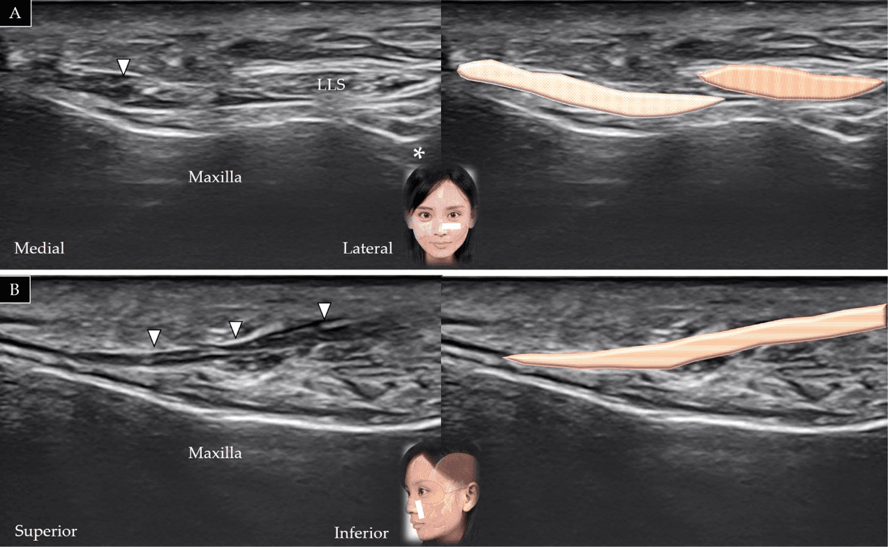 보툴리눔독소 - 상순코날개거근(levator labii superioris alaeque nasi)의 단축(A)과 장축(B)에 대한 초음파 스캔 및 도식적 표현