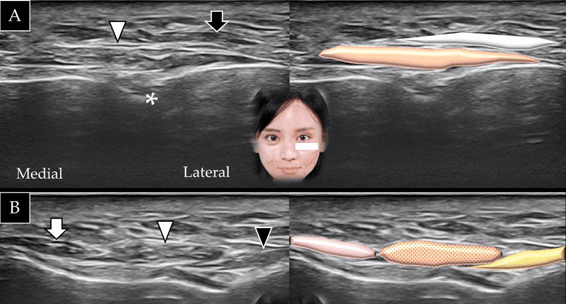 보툴리눔독소 - 상순거근(levator labii superioris)(흰색 화살표와 갈색 음영)과 구각거근(levator anguli oris)(검은색 화살표