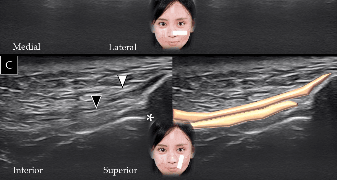 보툴리눔독소 - 상순거근(levator labii superioris)(흰색 화살표와 갈색 음영)과 구각거근(levator anguli oris)(검은색 화살표