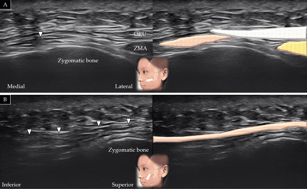 보툴리눔독소 - 소관골근(zygomaticus minor)의 단축(A)과 장축(B)에 대한 초음파 스캔 및 도식적 표현입니다. ORU와 흰색 음영은 눈둘레근(o