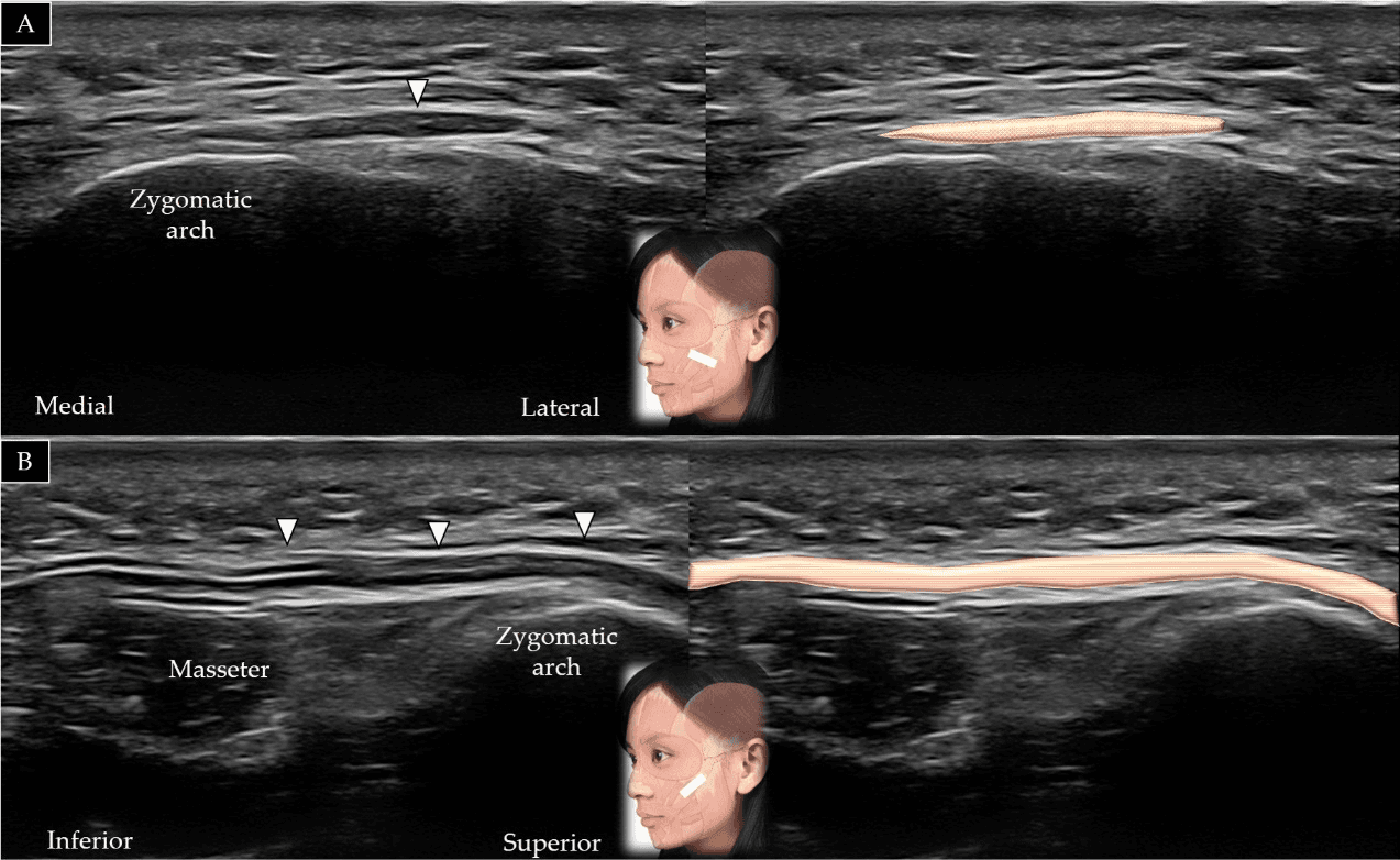 보툴리눔독소 - 대관골근(zygomaticus major)의 단축(A)과 장축(B)에 대한 초음파 스캔 및 도식적 표현입니다. 흰색 화살표와 갈색 음영은 대관골