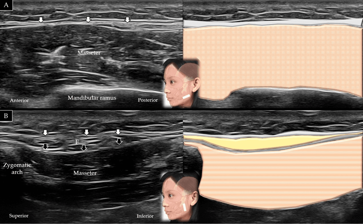 보툴리눔독소 - 교근(masseter)의 단축(A)과 장축(B)에 대한 초음파 스캔 및 도식적 표현입니다. 흰색 화살표와 회색 음영은 표재성 근건막계(super