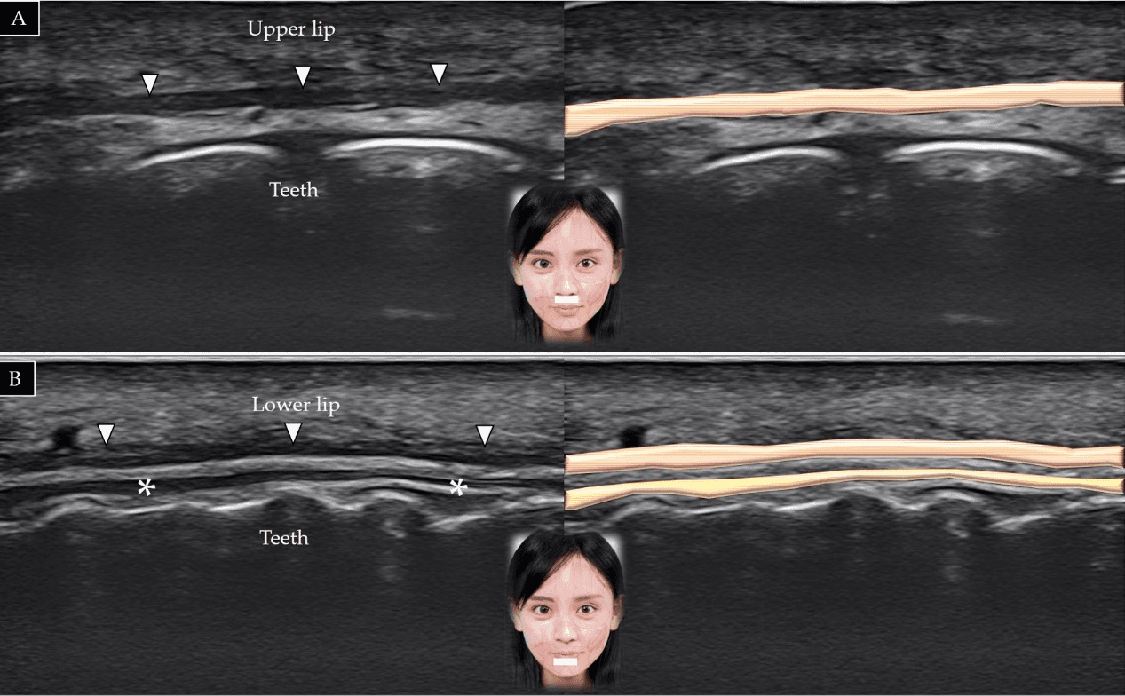 보툴리눔독소 - 하인중(A) 위와 순하악주름(B) 위에서 입둘레근(orbicularis oris)의 장축에 대한 초음파 스캔 및 도식적 표현입니다. 흰색 화살표