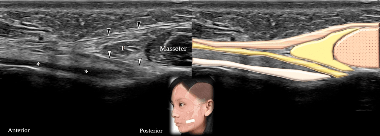보툴리눔독소 - 볼근(buccinator)(흰색 화살표와 짙은 노란색 음영)과 웃음근(risorius)(검은색 화살표와 갈색 음영)을 보여주는 초음파 스캔(장축