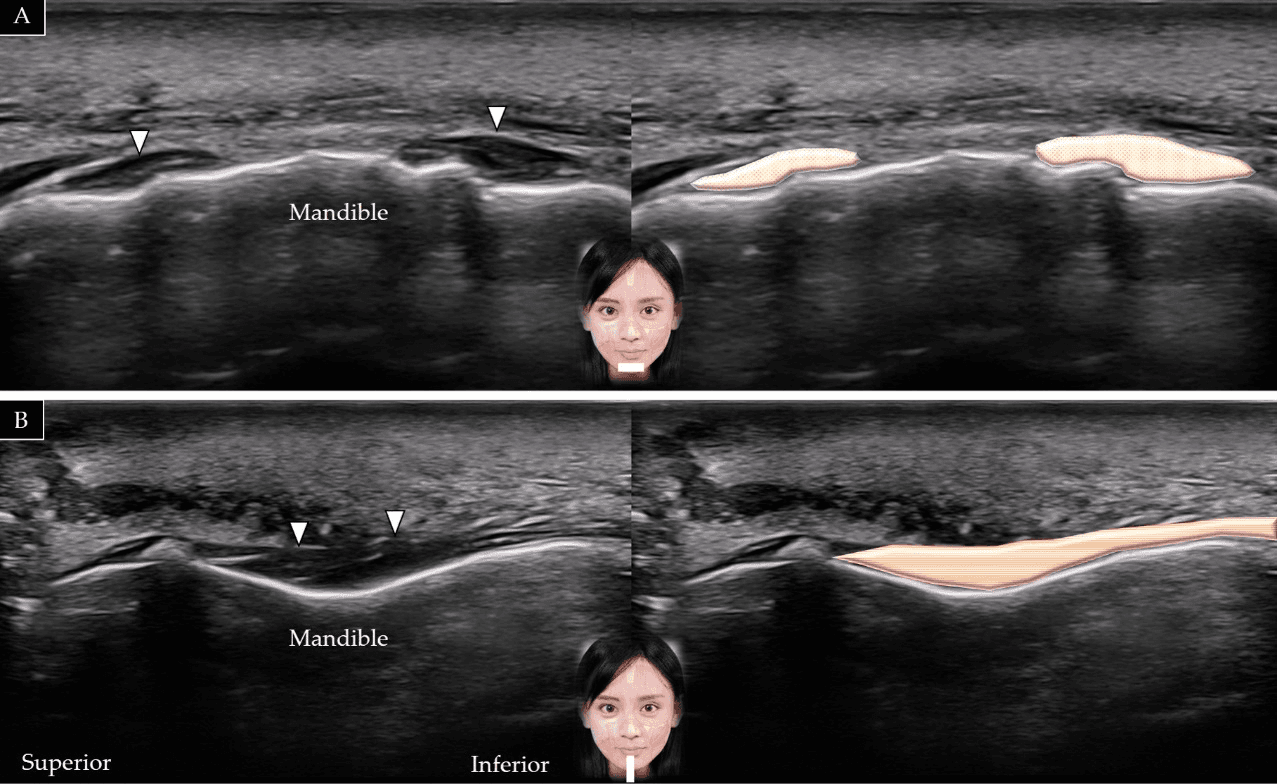 보툴리눔독소 - 턱근(mentalis)의 단축(A)과 장축(B)에 대한 초음파 스캔입니다. 흰색 화살표와 갈색 음영은 턱근을 나타냅니다