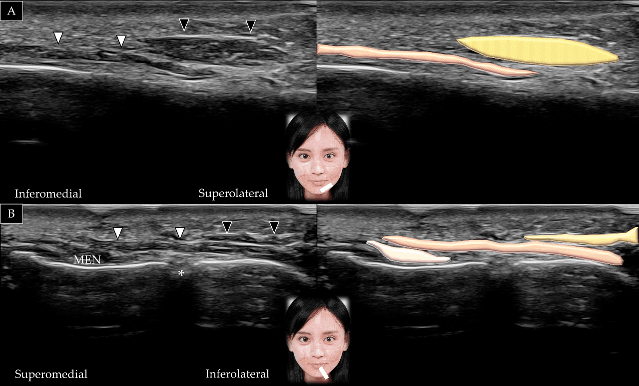 보툴리눔독소 - 턱근의 외측 가장자리 위에서 하순내림근(depressor labii inferioris)(흰색 화살표와 갈색 음영)과 구각내림근(depresso