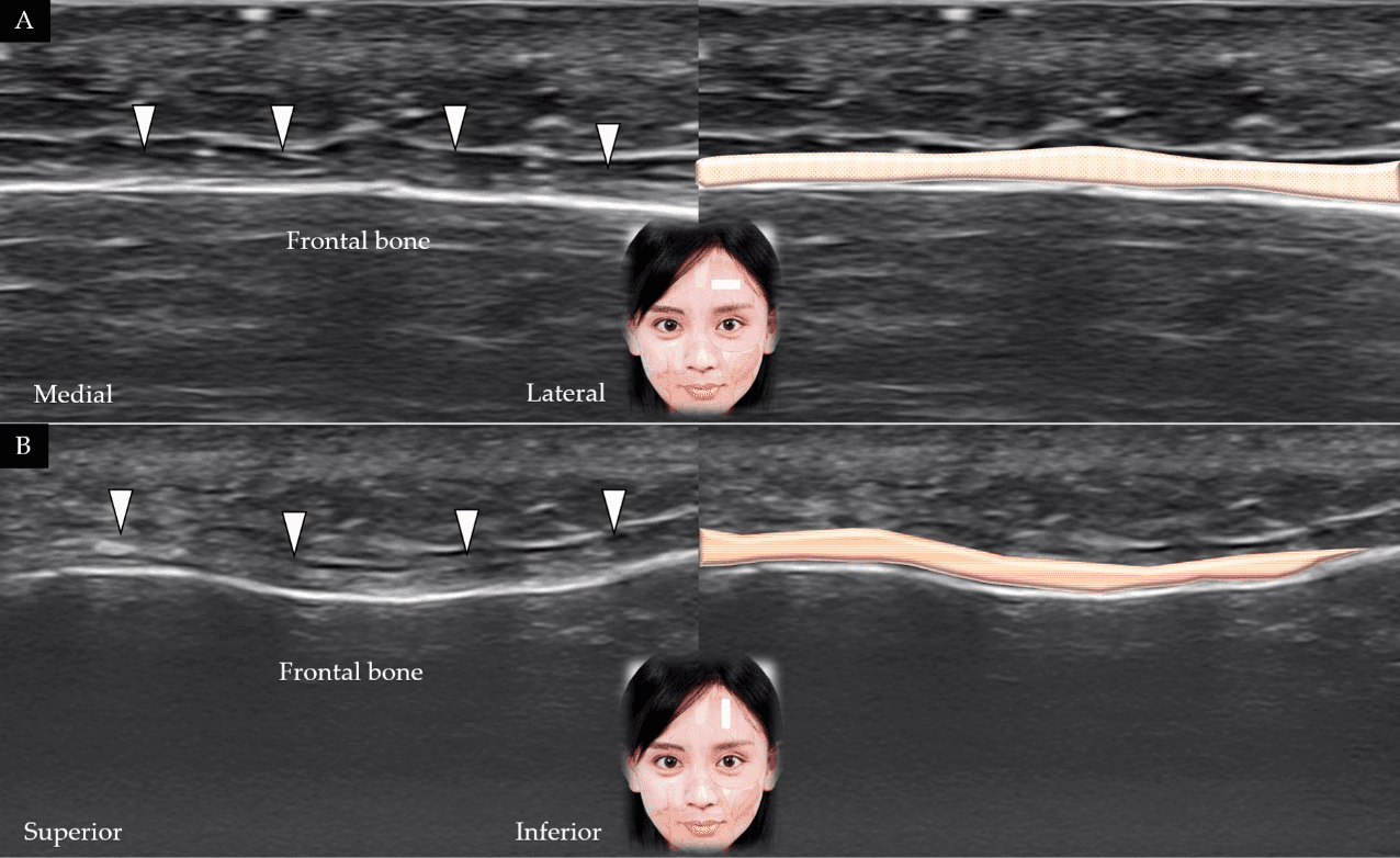 보툴리눔독소 - 전두근(frontalis muscle)의 단축(A)과 장축(B)에 대한 초음파 스캔 및 도식적 표현입니다. 흰색 화살표와 갈색 음영은 전두근을 