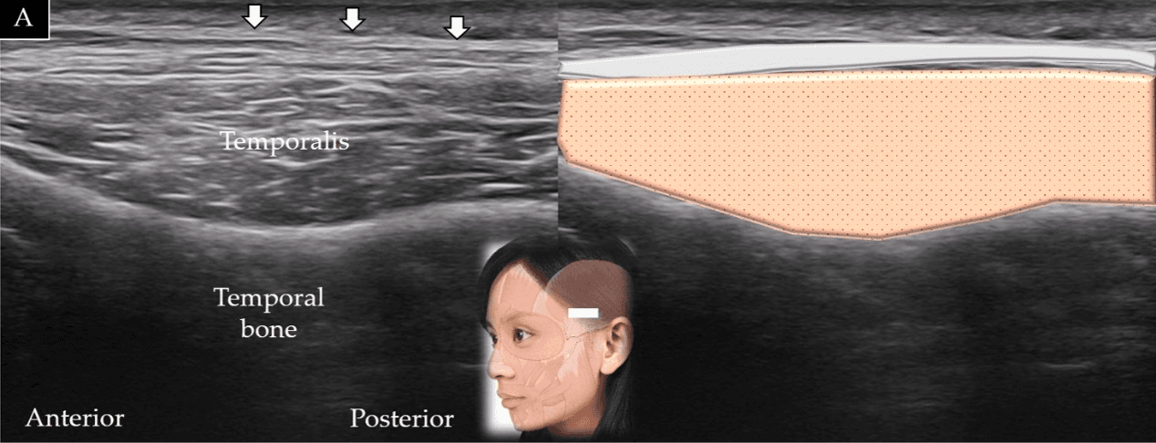 보툴리눔독소 - 측두근(temporalis muscle)의 단축(A)과 장축(B)에 대한 초음파 스캔 및 도식적 표현입니다. 흰색 화살표와 밝은 회색 음영은 측