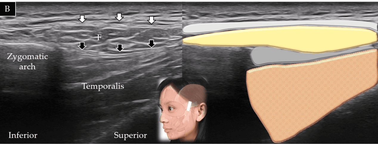 보툴리눔독소 - 측두근(temporalis muscle)의 단축(A)과 장축(B)에 대한 초음파 스캔 및 도식적 표현입니다. 흰색 화살표와 밝은 회색 음영은 측