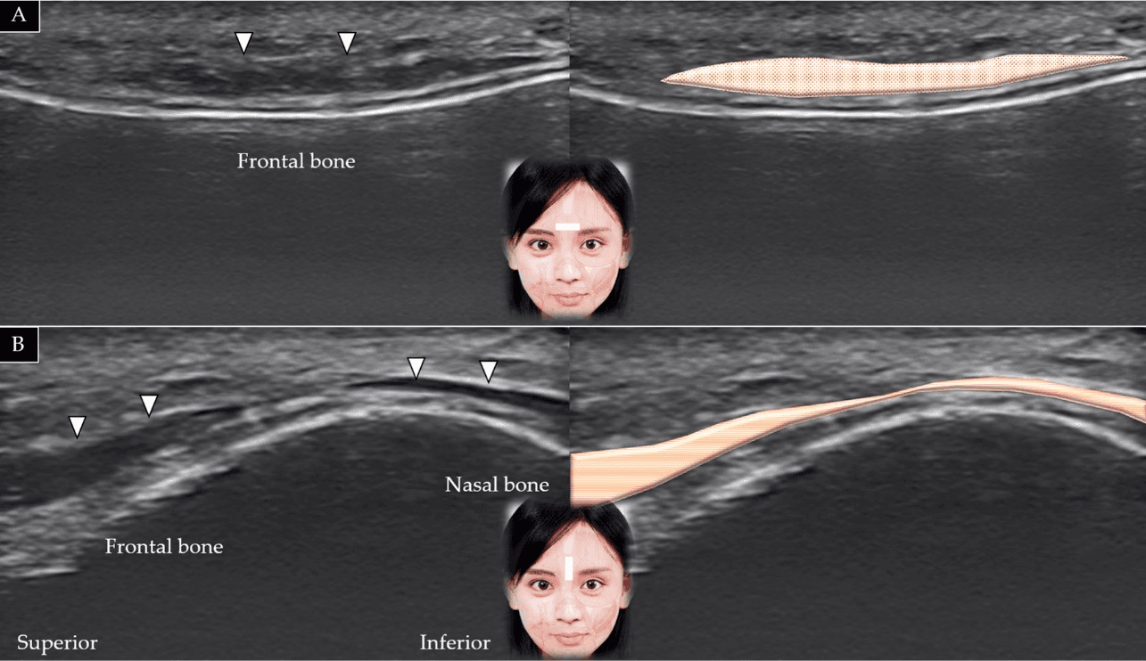 보툴리눔독소 - 비근근(procerus muscle)의 단축(A)과 장축(B)에 대한 초음파 스캔 및 도식적 표현입니다. 흰색 화살표와 갈색 음영은 비근근을 나