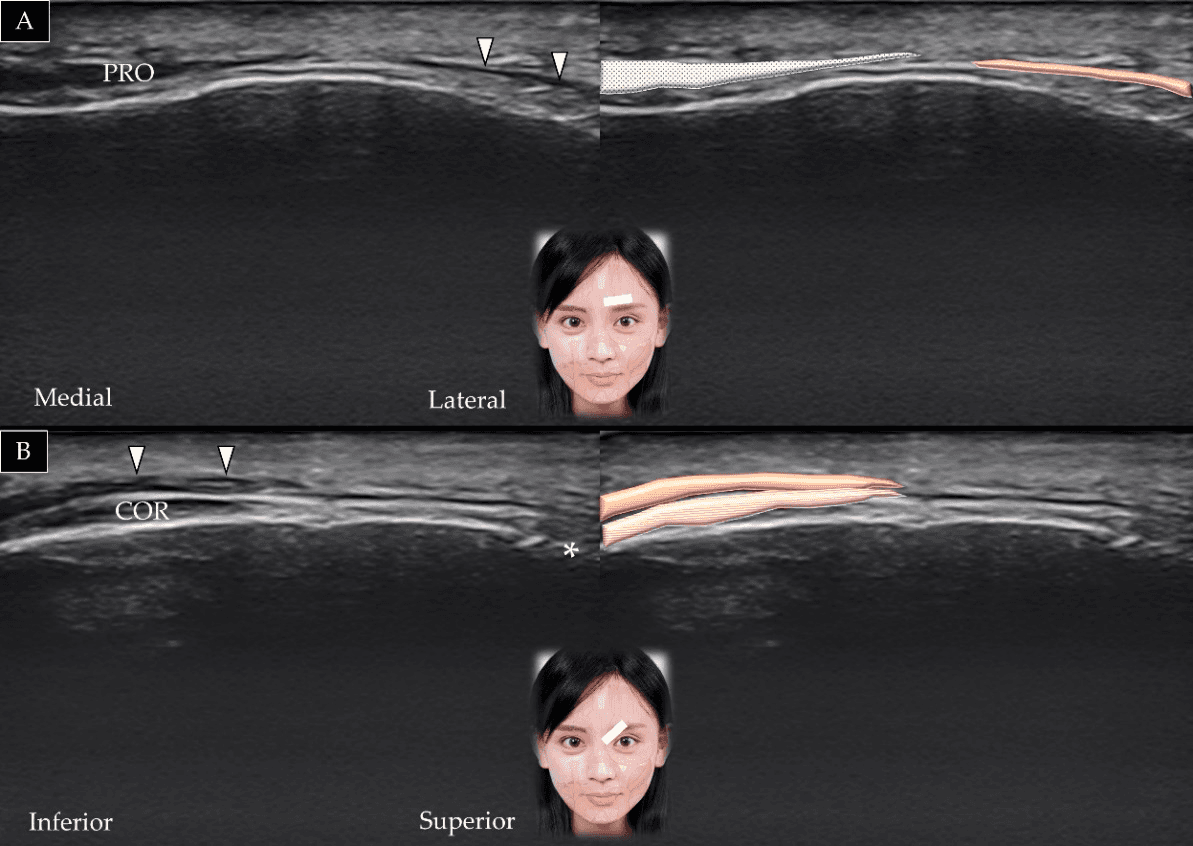 보툴리눔독소 - 눈썹내림근(depressor supercilii)의 단축(A)과 장축(B)에 대한 초음파 스캔 및 도식적 표현입니다. *는 안와상공(suprao